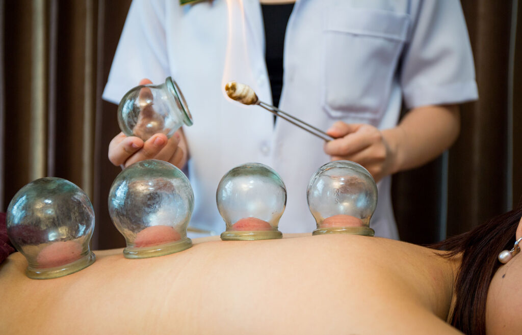 Cupping near me, cupping therapy Ft. Myers, FL, Naples, FL, AcuHerbal Wellness Center, traditional Chinese medicine, alternative medicine