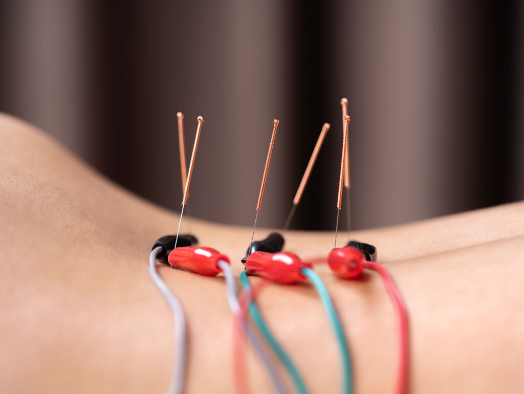 Electromagnetic impulse acupuncture, electromagnetic acupuncture near me, AcuHerbal Wellness Center, Ft Myers, FL, Naples, FL, acupuncture, Traditional Chinese Medicine, holistic medicine
